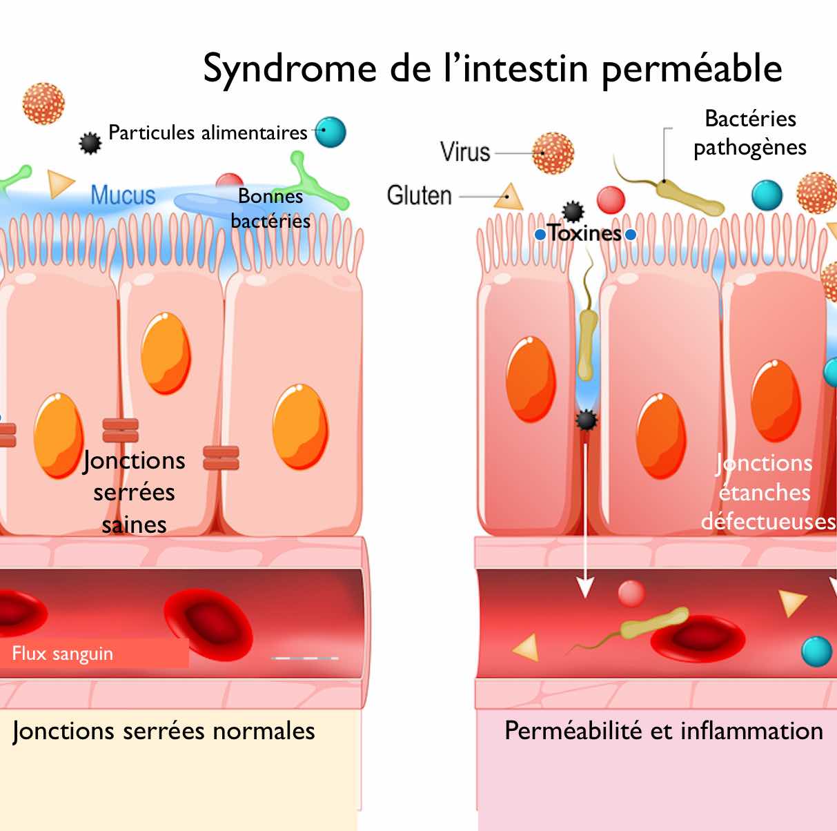 Le syndrome de l'intestin perméable